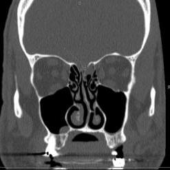 鼻窦的计算机断层扫描(CT)显示右侧筛窦颅底缺损引起自发性脑脊液泄漏