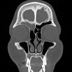 CT showing a recurrent left frontal sinus inverted papilloma