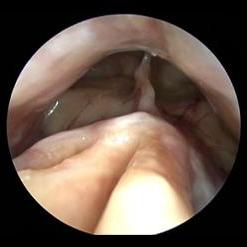 Postoperative appearance after removal of nasal polyps 