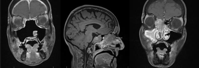 MRI of a left olfactory neuroblastoma before and after resection